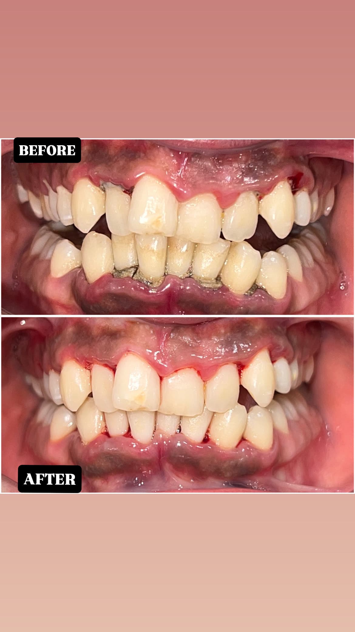 Gum Treatment