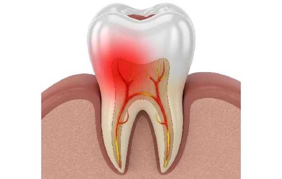 Root Canal Treatment in Thakur Village, Kandivali, Borivali